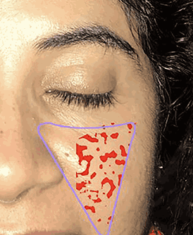 AI skin analysis image