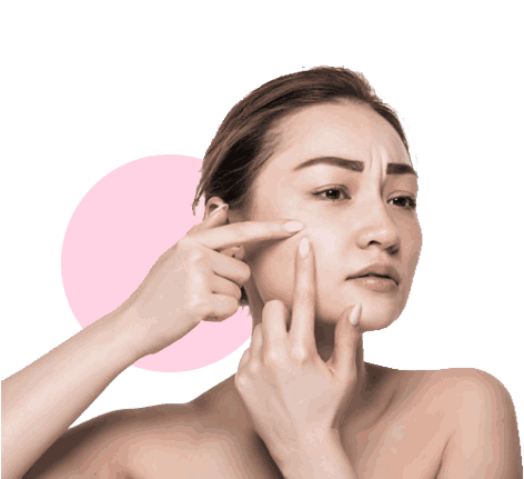 Women having acne on face