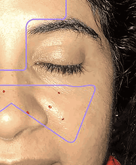 Advanced AI Skin Analysis