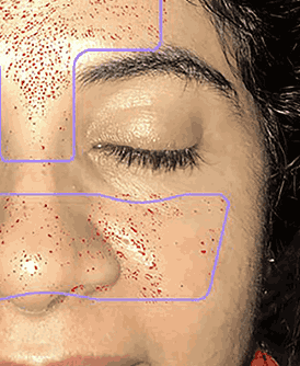 Advanced AI Skin Analysis