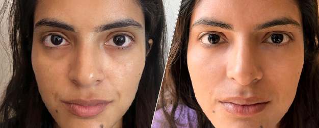 before and after comparison showcasing the results of an under-eye treatment