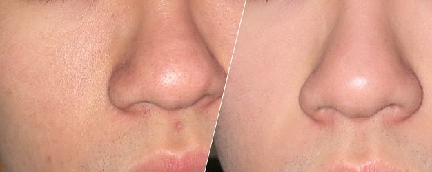 before-and-after comparison of skin treatment