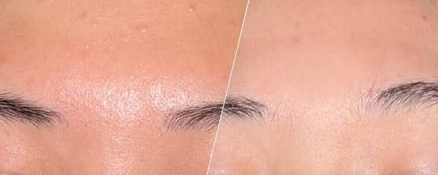 Before and after image of forehead skin
