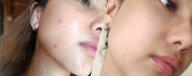 before-and-after comparison of acne skin treatment
