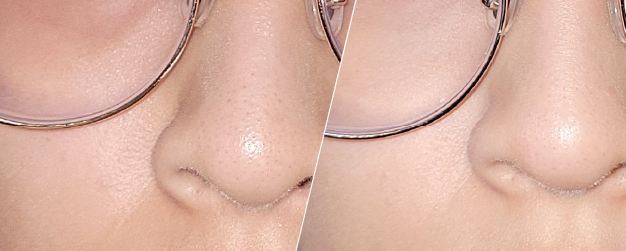 Before and after image of blackheads
