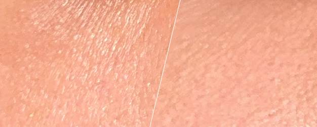 before-and-after comparison of skin treatment