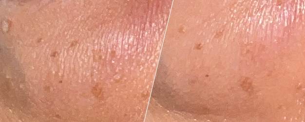 before-and-after comparison of dry skin treatment