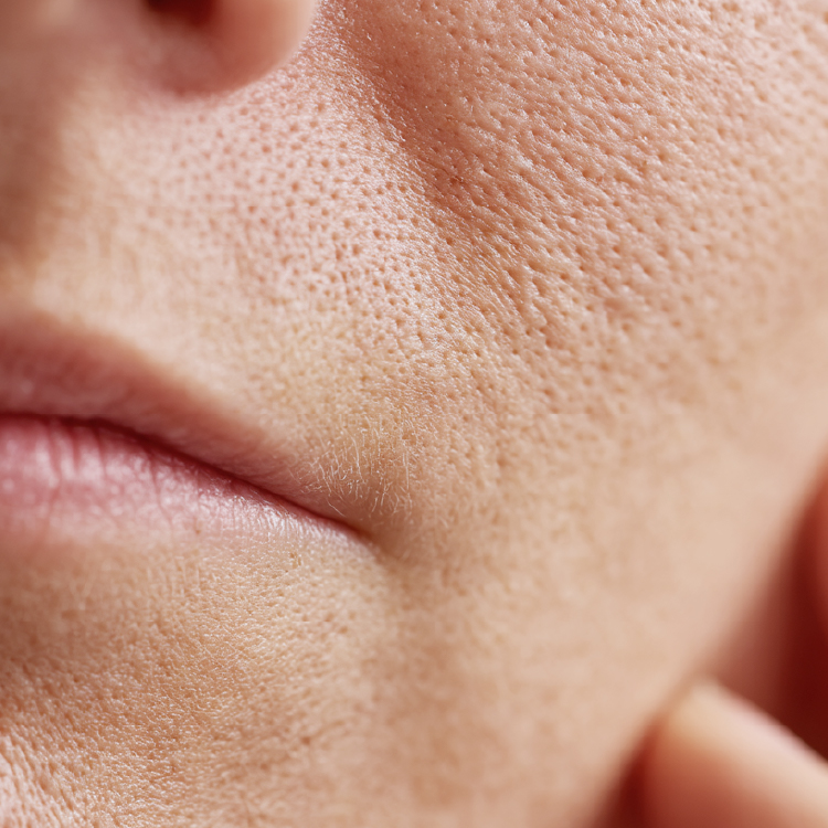 Enlarged Pores