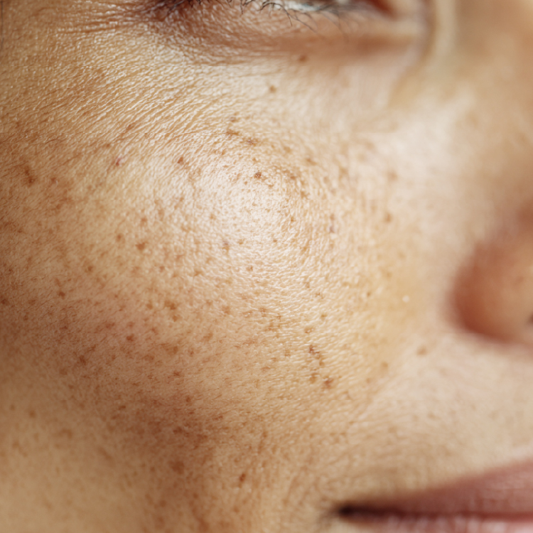 Spots and Dullness